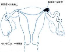 广州双胞胎供卵-堕胎是造成输卵管堵塞的主要原因